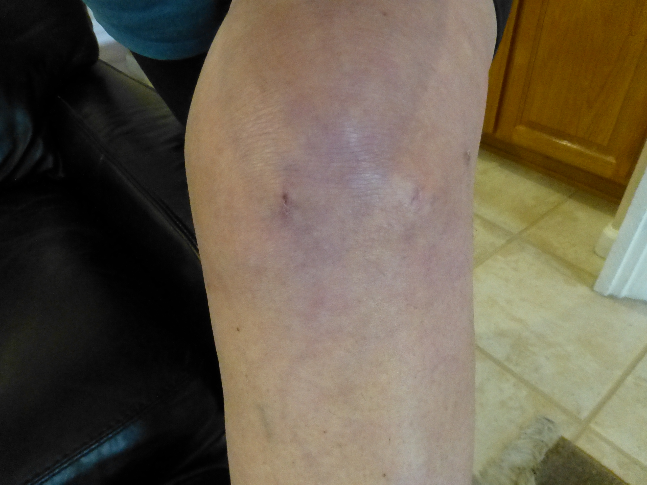 August 5, 2013 Knee Arthroscopy today’s worry